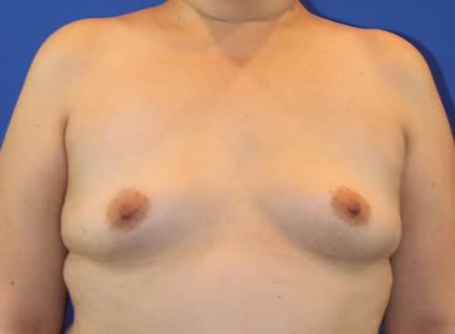 Before Image: Patient Case #3820 - front