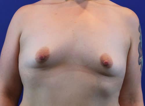 Before Image: Patient Case #3028 - front