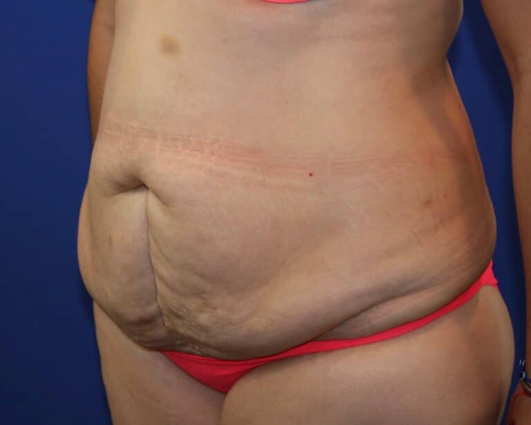 Before Image: Patient Case #3873 - left-front-oblique