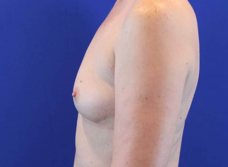 Before Image: Patient Case #2995 - left-side