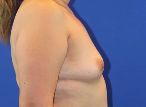 Before Image: Patient Case #3820 - right-side