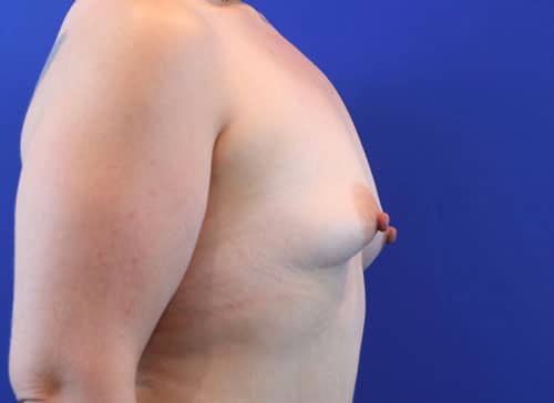 Before Image: Patient Case #3028 - right-side