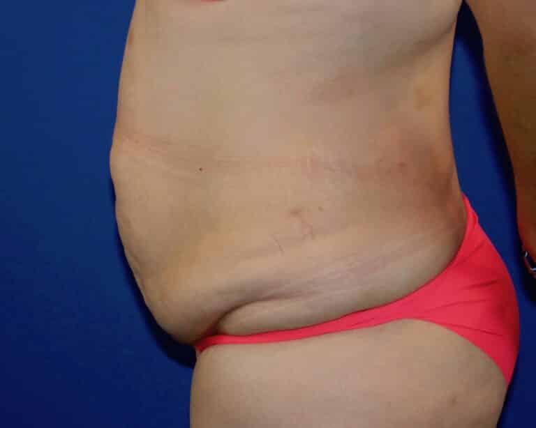 Before Image: Patient Case #3873 - left-side