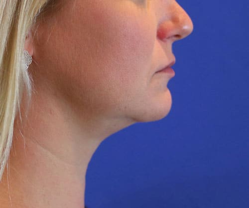 After Image: Patient #1000 - right-side