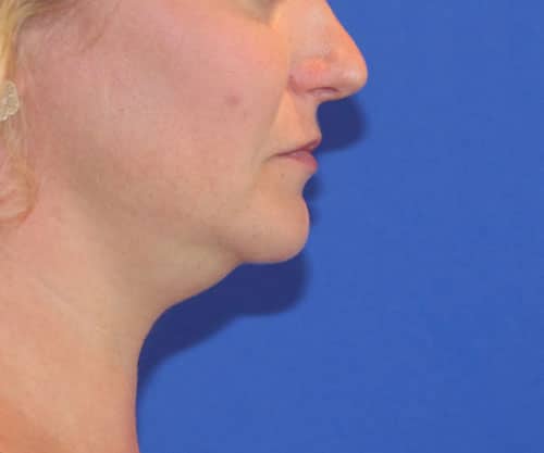 Before Image: Patient #1000 - right-side