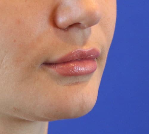 After Image: Case #1000 - right-front-oblique