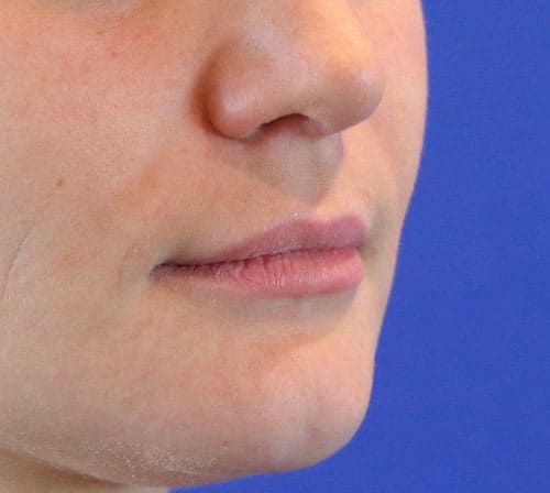 Before Image: Case #1000 - right-front-oblique