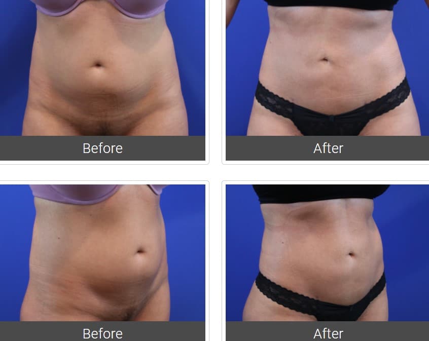 Liposuction Treatment Dallas TX