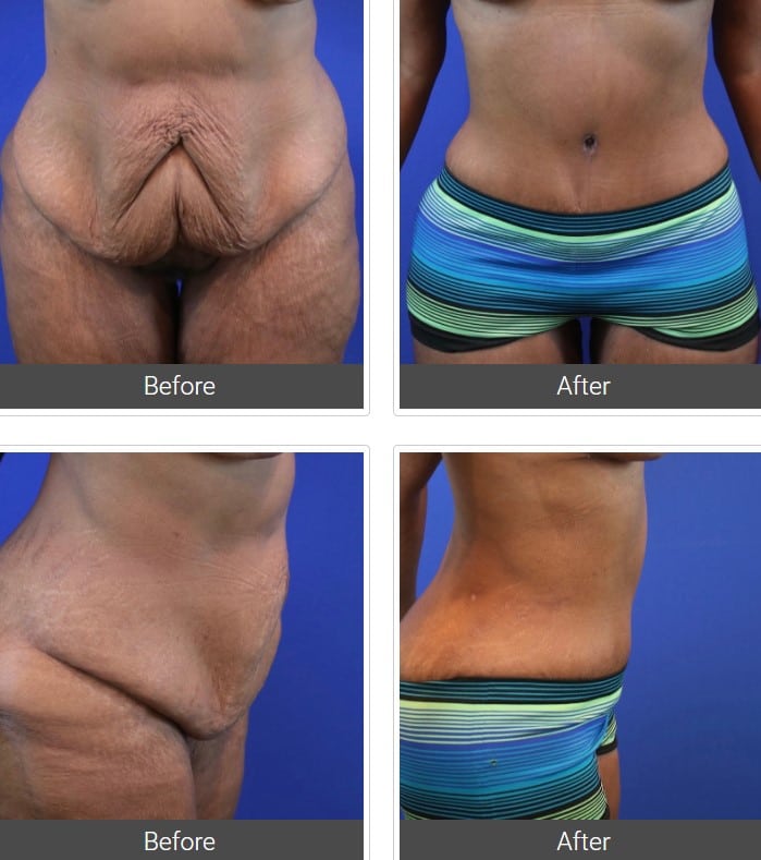 front and side view of before and after tummy tuck, with much tighter stomach after procedure