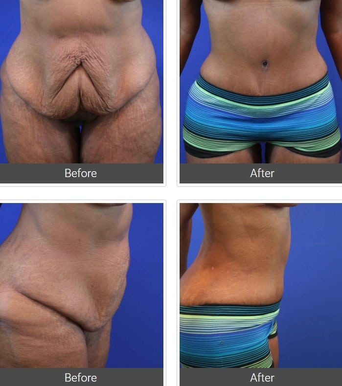before and after tummy tuck Dallas TX