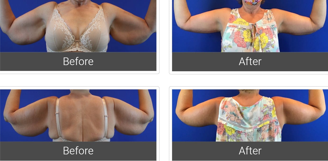 A before and after comparison of a young Caucasian woman who had a  brachioplasty. Corrective arm lift surgery which removes the sagging fat  layer from the triceps area. Photos