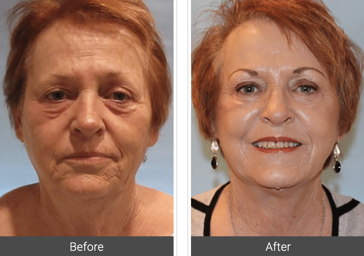 Facelift Before & After Photos