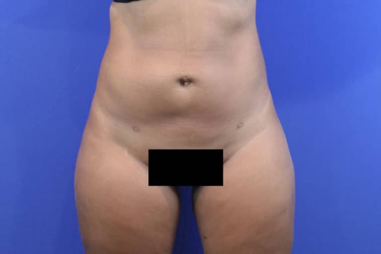 After Image: Patient Case #3280 - front