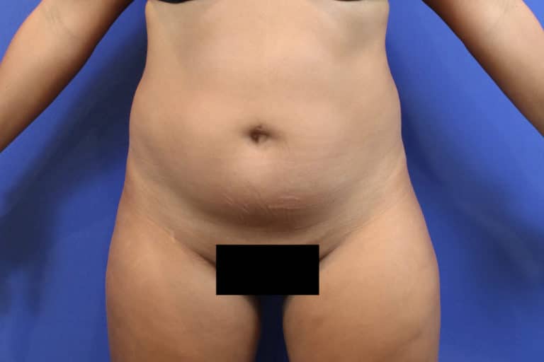 Before Image: Patient Case #3280 - front