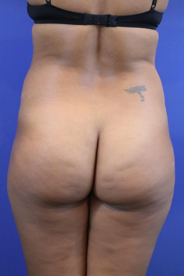 Before Image: Patient Case #3280 - back