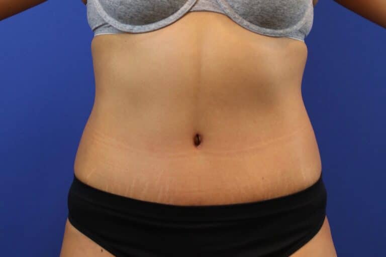 After Image: Patient Case #3893 - front