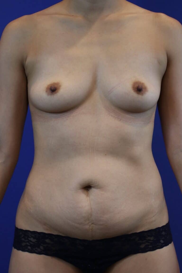 Before Image: Patient Case #3189 - front