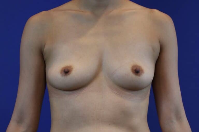 Before Image: Patient Case #3190 - front