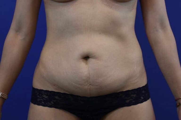Before Image: Patient Case #3191 - front