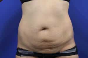 Before Image: Patient Case #3893