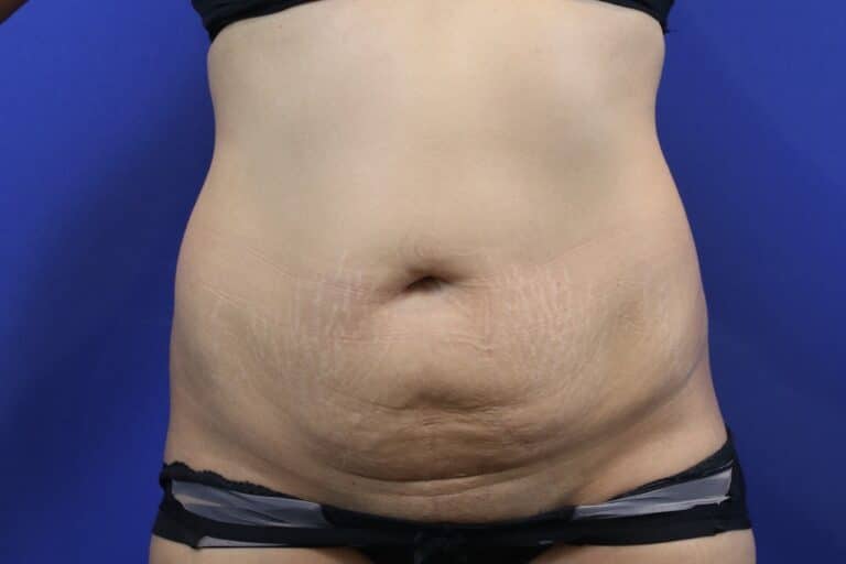 Before Image: Patient Case #3893 - front