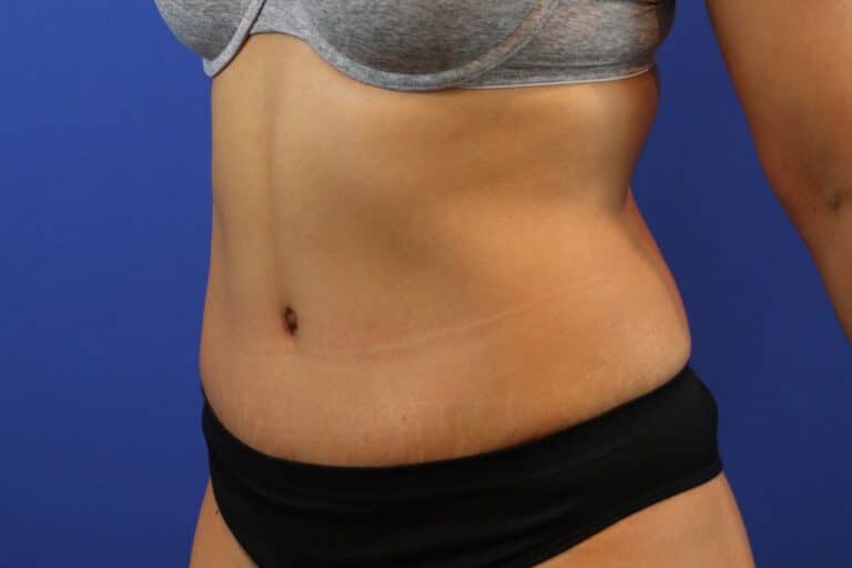 After Image: Patient Case #3893 - left-front-oblique