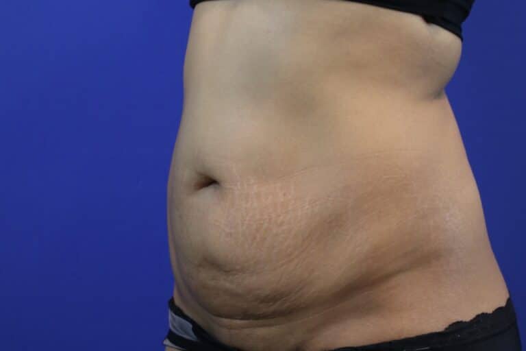 Before Image: Patient Case #3893 - left-front-oblique