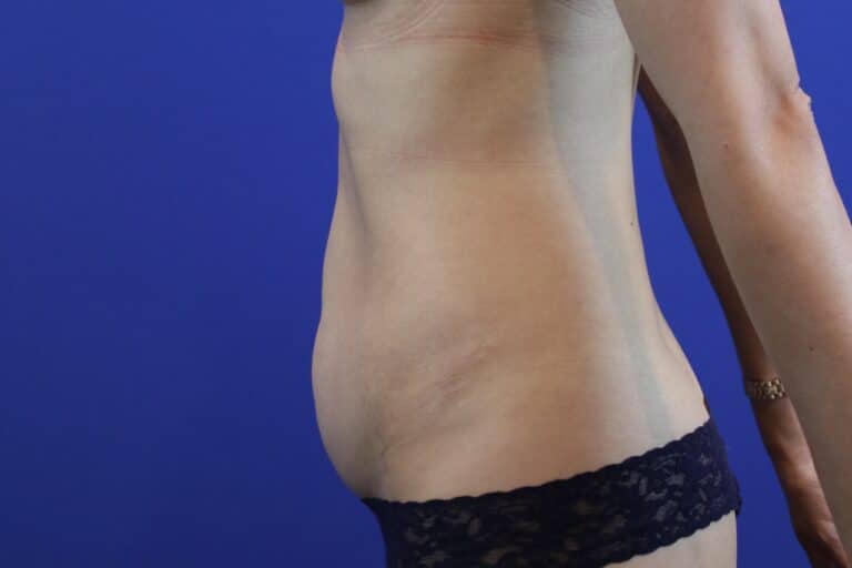 Before Image: Patient Case #3191 - left-side