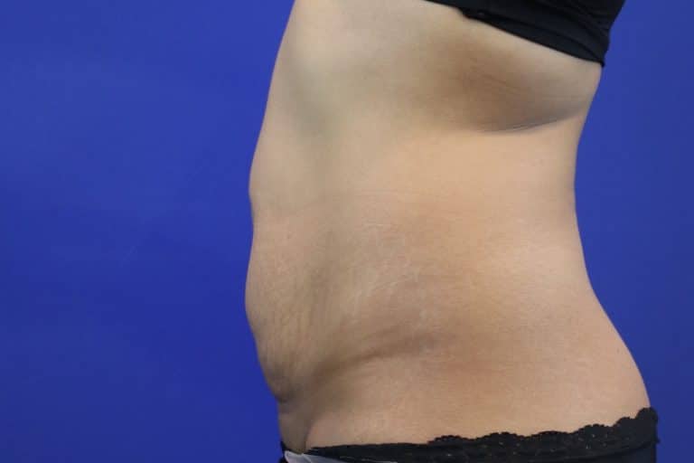 Before Image: Patient Case #3893 - left-side