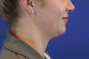 Before Image: Patient Case #3264