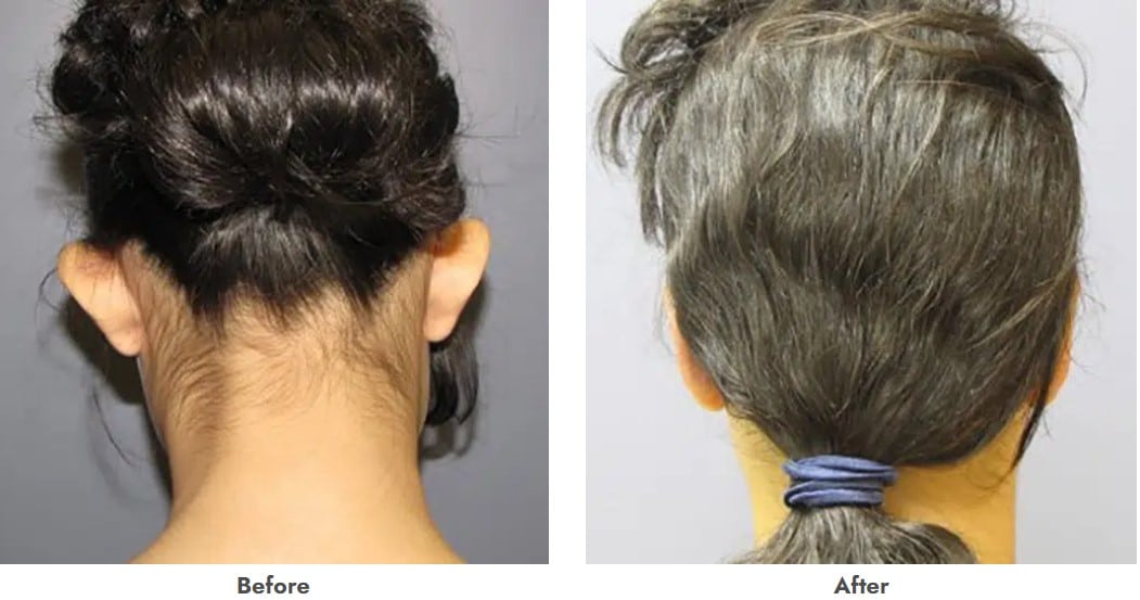 Before and after ear surgery Dallas TX