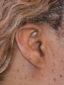 after Split Earlobe Repair Dallas TX