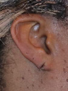 before Split Earlobe Repair Dallas TX