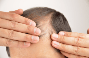 man controls hair loss