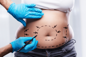 liposuction