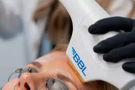 woman receiving bbl laser skin treatment on forehead from professional holding device