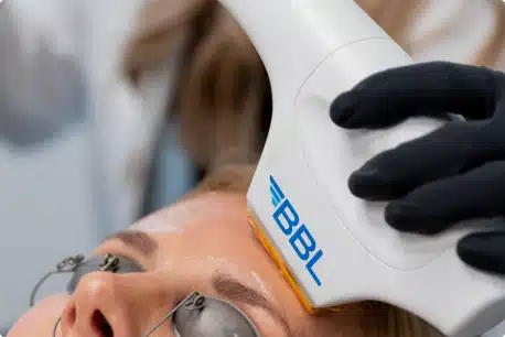 Group 1018 BBL Hero Laser Skin Treatment Dallas TX