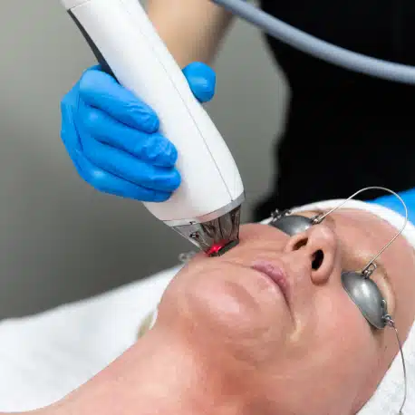 patient wearing protective glasses undergoing moxi laser treatment from medical professional