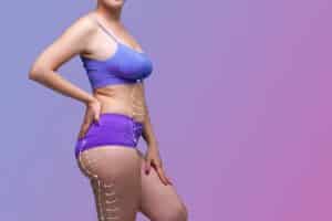 Leg,,Buttocks,,Abdomen,Liposuction,,Fat,And,Cellulite,Removal,Concept,,Overweight