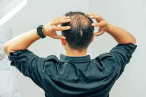 NeoGraft for Male Pattern Baldness