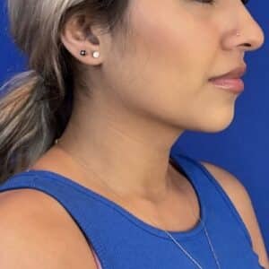 After Image: Submental (Chin) Liposuction