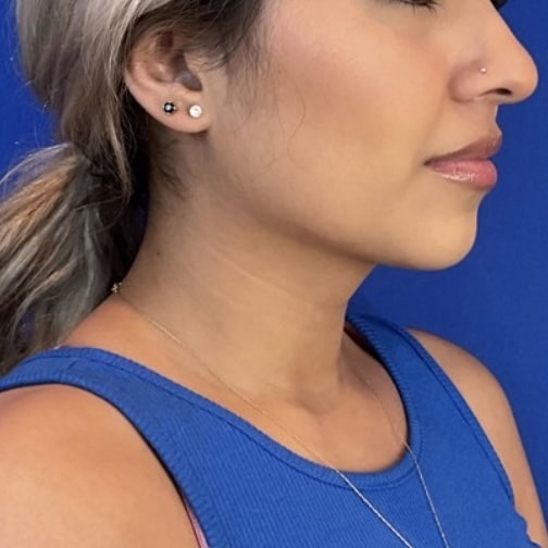 After Image: Submental (Chin) Liposuction - right-front-oblique
