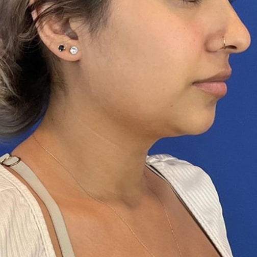Before Image: Submental (Chin) Liposuction - right-front-oblique