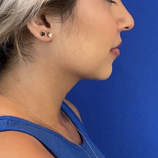 After Image: Submental (Chin) Liposuction - right-side