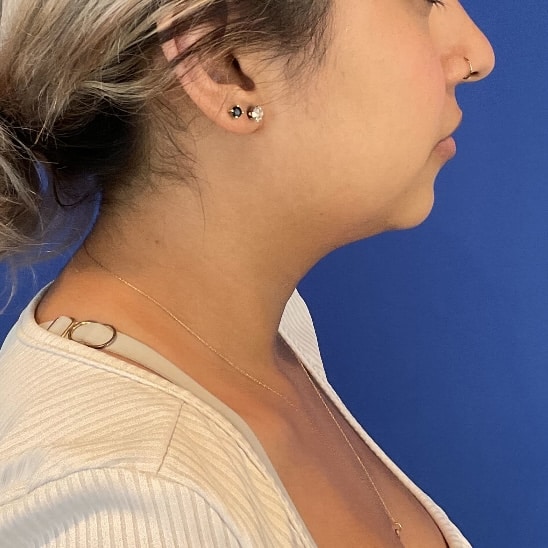 Before Image: Submental (Chin) Liposuction - right-side
