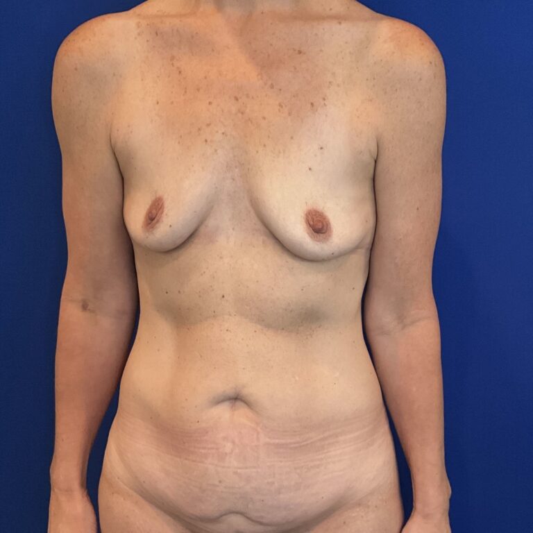 Before Image: Patient Case #6251 - front