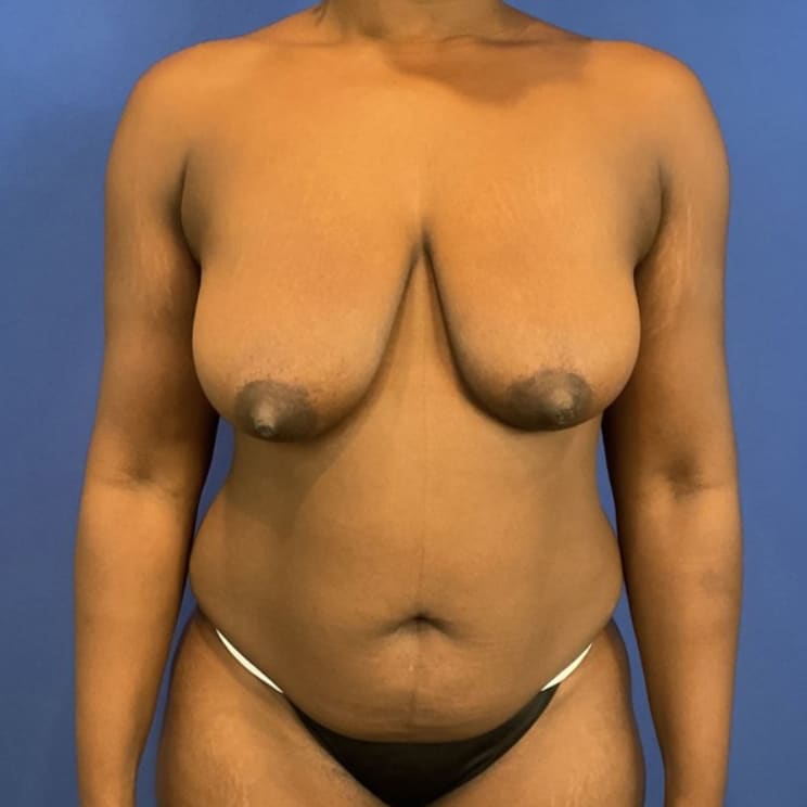 Before Image: Patient Case #6263 - front