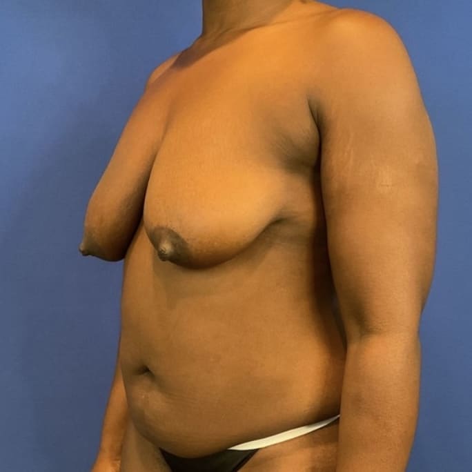 Before Image: Patient Case #6263 - left-front-oblique