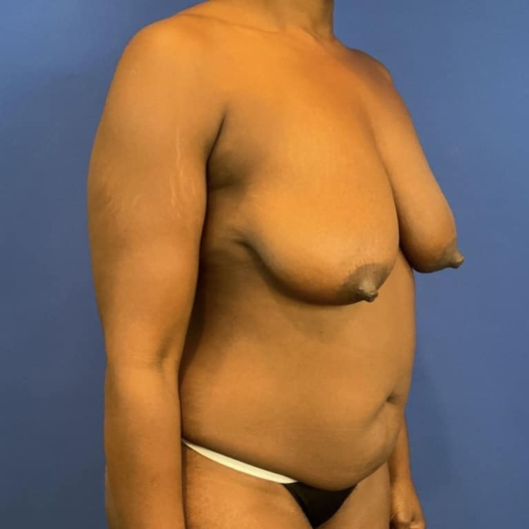 Before Image: Patient Case #6263 - right-front-oblique