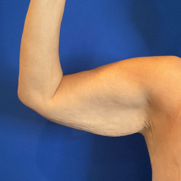 Before Image: Patient Case #6343 - front